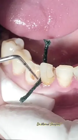 Fiber post & composite after root canal treatment of anterior canin tooth #dentist #teeth #dentista #tooth #طبيب_اسنان #root #dental #composite #retraction_cord #fiber_post 
