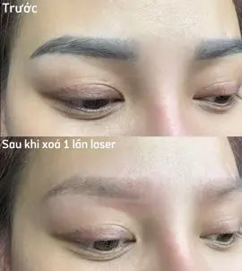 Sau khi xoá laser 1 lần duy nhất. Mày đậm xấu muốn xoá làm lại ăn Tết thì thời điểm này là quá hợp lý rồi 🥰 #xoalaserchanmay #laserpico 