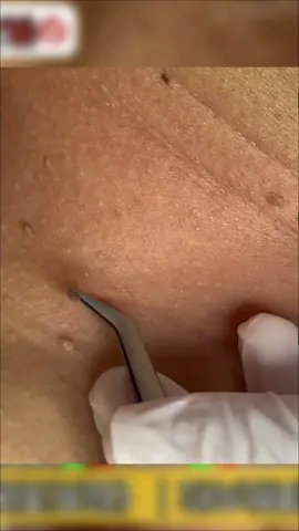 #pimplepoppersatisfying #blackheads #blackhead #pimples #pimple 