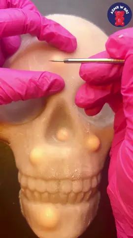 Those cheek bones though! #satisfying #fyp #relax #acne #asmr #capcut_edit #mochipimplepop 