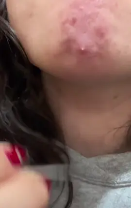 #cravos #brufoli #blackhead #zit #pimples_brufoli_ #popping #asmr #zits #pimples #granos #acne #popper #pimple #pimples_brufoli #granosyespinillas #pimplepop 