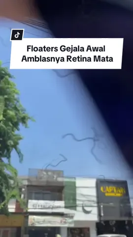 Membalas @FebryXploit Guyss, kenali gejala awal untuk menghindari ablatio retina, jangan disepelekan ya, bahaya⚠️ #pov #ablatioretina #kebutaan #glaukoma #floaters 