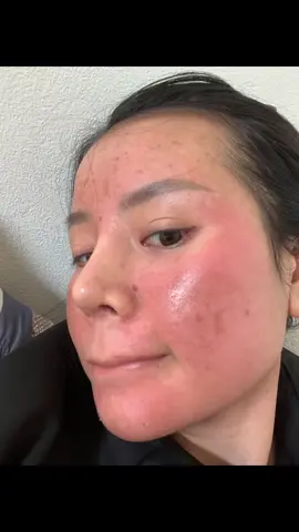 Có ai peel da xong da bị mẩn đỏ và bị xưng như mình không ạ, streets quá. Lần trước mình peel nhưng k bị như này nên lo quá 😥 #xuhuong #xuhuongtiktok 
