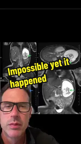 Believe it or not! 😳How did that get above a baby’s kidney⁉️ #neonatal #meded #medtok #neonatology #obgyn #pediatrics  #twinsoftiktok 