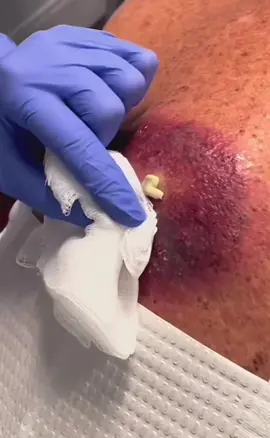 #cravos #brufoli #blackhead #zit #pimples_brufoli_ #popping #asmr #zits #pimples #granos #acne #popper #pimple #pimples_brufoli #granosyespinillas #pimplepop 