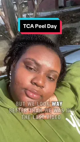 showing yall my skin right after my TCA peel! we did 3 rounds of the 15 percent. im going to be showing yall my process so if you have any questions, feel free to ask 🥰 #chemicalpeel #chemicalpeelseason #tcachemicalpeel #hyperpigmentation 