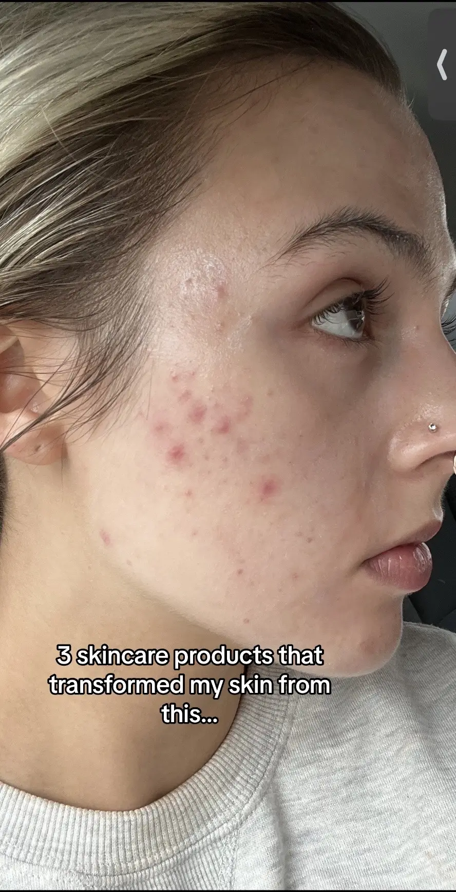 #SkinCare #acne #acneprone #winlevi #effeclarduo #arazlo