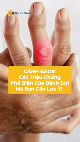 Cảnh Báo! Các Triệu Chứng Phổ Biến Của Bệnh Gút Mà Bạn Cần Lưu Ý!  Gút là một dạng viêm khớp phổ biến mà nguyên nhân chính là do nồng độ axit uric trong máu tăng cao. Căn bệnh này khiến nhiều người cực kì khó chịu bởi các triệu chứng mà nó gây ra.   Triệu chứng điển hình nhất của gút là người bệnh xuất hiện những cơn đau khớp dữ dội. Các vị trí đau thường là ở:  - Khớp bàn chân, đặc biệt là ngón cái  - Mắt cá chân  - Bàn tay  - Cổ tay  - Khuỷu tay  - Đầu gối  Bên cạnh đó, ở vùng da bị đau còn có các biểu hiện như sưng, nóng, đỏ.  Những triệu chứng này thường xuất hiện đột ngột vào ban đêm, do đó làm ảnh hưởng nghiêm trọng đến chất lượng ngủ của người bệnh.   Thông thường, các cơn đau biểu hiện trầm trọng nhất trong vòng 12 đến 24 giờ sau khi phát bệnh và có thể kéo dài từ 1 đến 2 tuần.   Nếu không điều trị, bệnh gút có thể dẫn đến nhiều biến chứng nguy hiểm liên quan đến thận và tim mạch.   Vì vậy, khi xuất hiện các triệu chứng trên, bạn hãy đến ngay các trung tâm y tế, phòng khám uy tín để được bác sĩ thăm khám và chữa trị kịp thời.  Đồng thời, khám tổng quát định kỳ chính là biện pháp tốt nhất để bạn có thể theo dõi và bảo vệ sức khỏe một cách toàn diện.  Theo dõi ngay Doctor Check, để cập nhật những thông tin hữu ích; giúp bạn sống thọ hơn.  ------------    Doctor Check - Tầm Soát Bệnh Để Sống Thọ Hơn    Liên hệ hotline: 0989 01 01 01    Địa Chỉ Khám Tổng Quát Uy Tín Tại TPHCM    Địa chỉ phòng khám: 429 Tô Hiến Thành, Phường 14, Quận 10, Tp. Hồ Chí Minh    #doctorcheck #khamtongquat #khamsuckhoe #suckhoe #khamsuckhoetongquat #gout #gut #benhgut #axituric #axituriccao #tiktok #xuhuongtiktok #xuhuong #xh #LearnOnTikTok