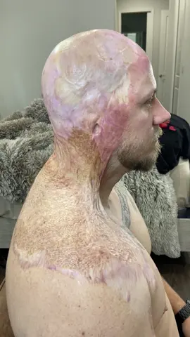 #electrocuted #bluecollarbabe #bluecollarboys #podcast #fyp #fypシ゚viral #scar #safteyfirst #bluecollar #fypage #dadlife #burnsurvivor #livelifetothefullest 