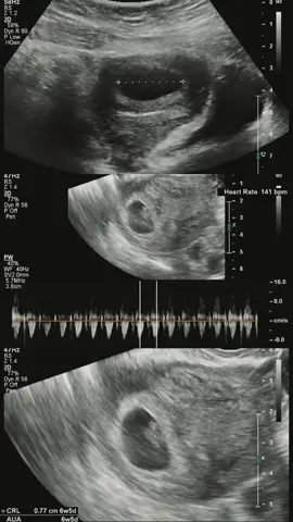 MasyaAllah Tabarakallah... Mau cerita sesikit tentang USG pertama ku ini kemarin..  Pas pertama ini hanya kelihatan kantong nya saja, kata dokter seperti ada gumpalan darah ,ditanya ibu ada flek tidak ,aku jawab tidak karna selama ini aku gak ada keluhan apapun karna aku dari hamil anak pertama 