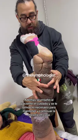 Un regalo navideño para nuestra paciente con #linfedemaprimario ❤️‍🩹  #linfedema #medicina #fisioterapia #enfermeria #rehabilitacion #medicine #lymphedema #Science #health #lymphaticdrainage #medstudent 