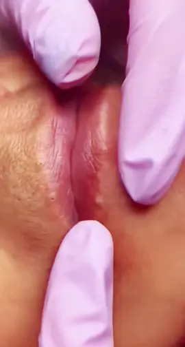 #cravos #brufoli #blackhead #zit #pimples_brufoli_ #popping #asmr #zits #pimples #granos #acne #popper #pimple #pimples_brufoli #granosyespinillas #pimplepop 