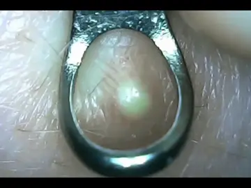 What day is it? #pimple #fyp #satisfying #pop 