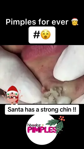 #pimple #medical #horror #blackhead #bigpimple #pimpleremoval #disgusting #pimplepop #cystexplosion #squeeze #squeezeyuk #skincare #acnetreatment #acne #pimples #satisfying #whiteheads #cyst #abscess #verysatisfying #christmas 