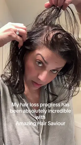 #hairloss #hairlosssolutions #hairlossjourney #hairlosstreatment #hairlosssolution #hairlosstransformation #beforeandafter #hairgrowthoil #amazinghairsaviour 