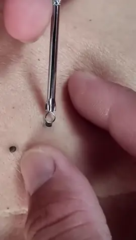 #cravos #brufoli #blackhead #zit #pimples_brufoli_ #popping #asmr #zits #pimples #granos #acne #popper #pimple #pimples_brufoli #granosyespinillas #pimplepop 