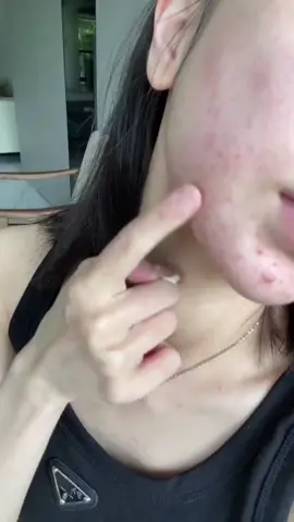 #tiktok #skinwhitening #removeacne #antiacnecream #aichunbeauty #finegoods #practical 
