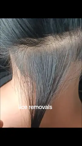 lice removals #lice #liceremoval #fyp #satisfying #omg #viral 