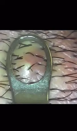 #cravos #brufoli #blackhead #zit #pimples_brufoli_ #popping #asmr #zits #pimples #granos #acne #popper #pimple #pimples_brufoli #granosyespinillas #pimplepop 