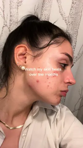 My skin evolution through the year ! (No I didn’t do accutane, my acne was mostly caused by hormonal imbalances and I healed it naturally, I show you how on my videos 🫶🏼) #skin #acne #skincare #skinbeforeandafter #acnebeforeandafter #hormoneimbalance #hormonalacne