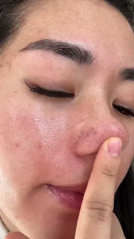 LOOK AT MY PORES 🫨 #medicube #medicubetonerpad #medicubezeroporepad #medicubetonerpad #medicubetoner #koreantonerpad #kbeautytonerpad 