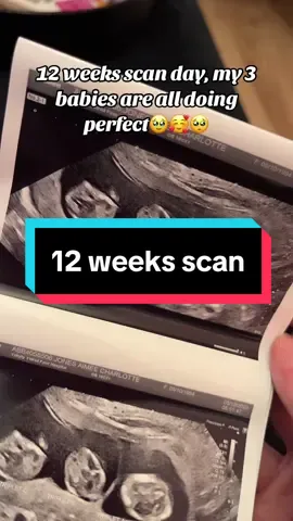 My gorgeous babies🥰🥹 #pregnancy #pregnancyjourney #fyp #pregnant #viral #fertilityjourney #foryou #foryoupage #fertility #iuisuccess #triplets #tripletpregnancy #12weekspregnant #12weekscan 