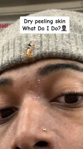 Help a brotha out🥲‼️  Drop some Tips and advice in the comments #dryskin #psoriasis #skincare #skin #xyzbca 
