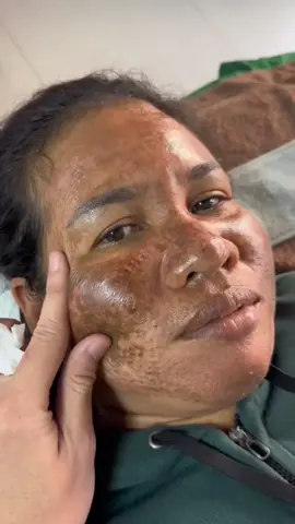 #top #flekhitam #skincare #foryourpage #fyp 