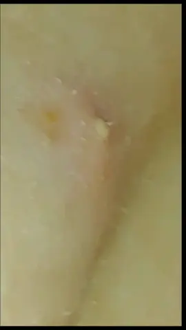 What did you think? #pimple #fyp #satisfying #pop 