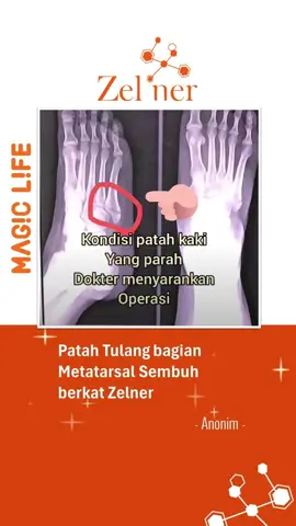 Wow!!!😱 Patah tulang sembuh... Ini dia Magical Exprience yang telah dirasakan salah satu pengguna Zelner, it's like a magic✨✨✨ Kandungan OLIGOPEPTIDA AKTIF dari kedelai Non GMO Organik Premium dapat menjadi solusi untuk melawan penuaan & membantu pemulihan ragam penyakit yang diakibatkan oleh kerusakan sel tubuh. Kini giliran Anda untuk merasakan juga Keajaiban dari Zelner!! Let's magic your life!!! #MagicLife #Zelner #oligopeptide #premium #testimoni #Soy #Nutrisi #experience 