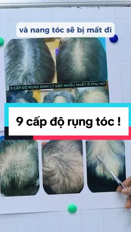 Thời gian , chi phí và kết quả phụ thuộc vào cấp độ rụng , hói của bạn! #coluatrongtoc #kichmoctoc #trirungtockichmoctoc #trirungsausinh #yêutocdai #rungtocsausinh #rungtocsausinh #rungtocsausinh #trirungtoc_hoidau 