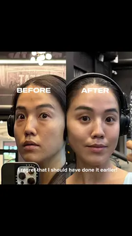 I finally did the eye-bag removal surgery in Japan💛 #eyebags #undereyebags #transformation #fyp 