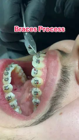 Braces Day 1🦷 Metal Braces Installation👍Located in Istanbul 🇹🇷 #braces #dental #bracestip 