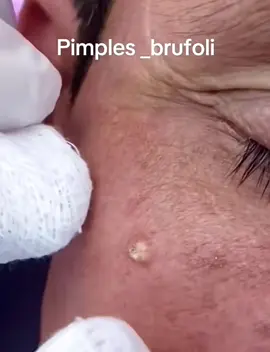 #cravos #brufoli #blackhead #zit #pimples_brufoli_ #popping #asmr #zits #pimples #granos #acne #popper #pimple #pimples_brufoli #pimplepop #granosyespinillas 