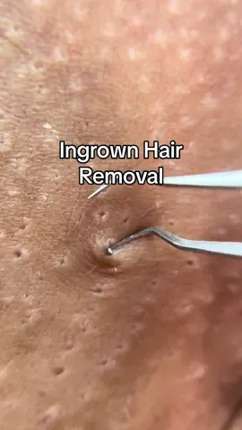 Even when you follow aftercare consistently, getting the occasional ingrown is normal. It just comes with the territory when you participate in any type of hair removal. (That's when I come in to pick it out 😝.) Although this may look painful, I was not hurting my client. I always check in to see how they're doing. 🫶🏼