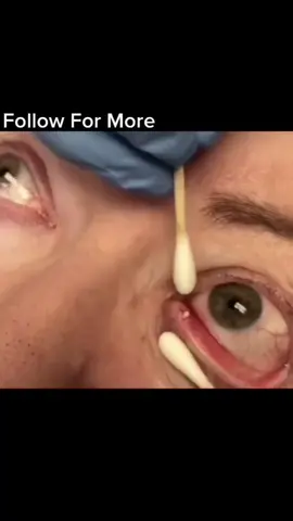💦💦 #pimple #fyp #satisfying #pop #onthisday 