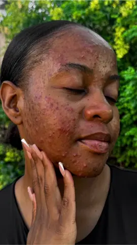 I am more than my acne.  #acnepositivity#acneproneskin#SkinPositivity#hormonalacne#acneconfidence#acnejourney#skinjourney#blackgirlswithacne#adultacne#sama28 #selflove#texturedskin#fyp