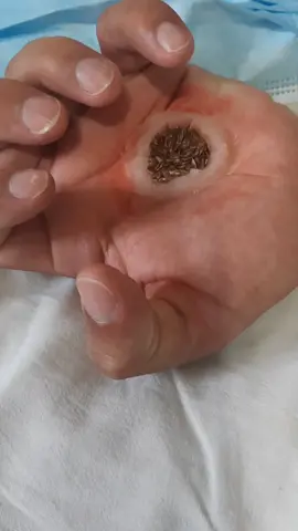 #asmr #trypophobia #satisfatory #lava #pimple 