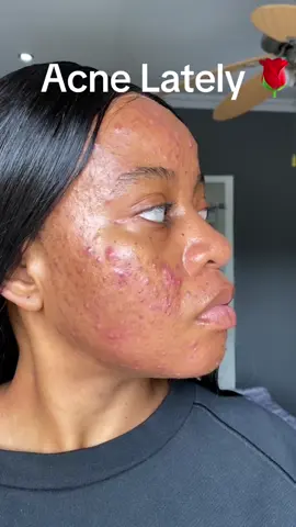 Hey Beautiful ❤️ I sincerely hope that this clarifies for you that having acne is natural and does not equate to being unattractive, filthy, or repulsive—or any other derogatory terms people may use to describe you.  I consider the fact that I am currently breaking out primarily on my forehead and right side of my face to be improvement. Never give up on yourself. ❤️ #acnepositivity #SAMA28 #acneproneskincare #fyp #blackgirlswithacne 
