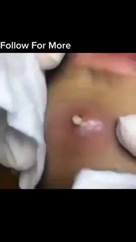 Big one #onthisday #pimple #fyp #satisfying #pop 