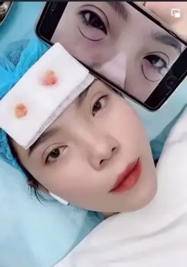 Lấy mỡ bọng mắt  Trẻ đẹp ra 10tuoi  là có thật