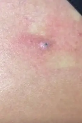 #cravos #brufoli #blackhead #zit #pimples_brufoli_ #popping #asmr #zits #pimples #granos #acne #popper #pimple #pimples_brufoli #granosyespinillas #pimplepop 