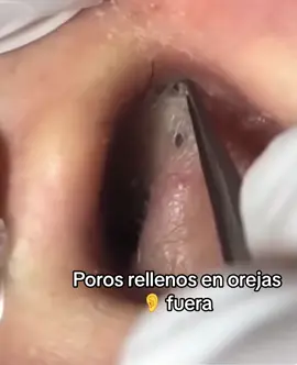 #Extracción #poros #granos#pelo #espinillas #limpiezafacial #acne #tratamientos 