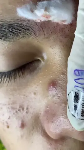 Blackheads on face #blackheads #fyp #blackheadreaction #blackheadremovals 