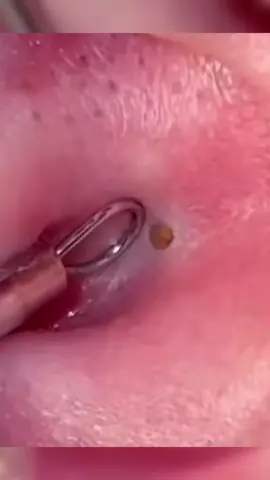 #pimplepoppersatisfying 