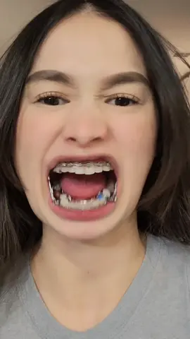 Replying to @puketzyyyy.0 I miss my Herbst so much ! 🥺 Posting my Drafts #draft #foryourpage #california #zairamonzon #zaira #tiktok #fypviral #xy #monzon #philippines #foryou #fyp #fypシ #fypシ゚viral #fypage #foryyou #foryou #xy #xyzbca #herbst #herbstappliance #tads #temporaryanchoragedevice #brace #suspension #tiktok #fypviral #viral #trending #overbite #class2 #overjet #braces #cantingsmile #gummysmile 