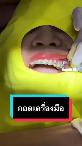 ถอดเครื่องมือ #ถอดเครื่องมือ #ถอดเครื่องมือจัดฟัน #รื้อเครื่องมือ #ถอดเครื่องมือพัทยา #ย้ายเคสพัทยา #จัดฟันพัทยา #ตัดเหงือกพัทยา #ทำฟันพัทยา  @ilike.dental  @ilike.dental  @ilike.dental 