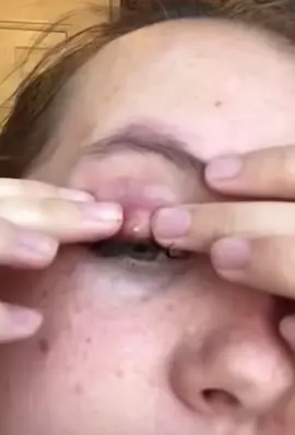#cravos #brufoli #blackhead #zit #pimples_brufoli_ #popping #asmr #zits #pimples #granos #acne #popper #pimple #pimples_brufoli #granosyespinillas #pimplepop 