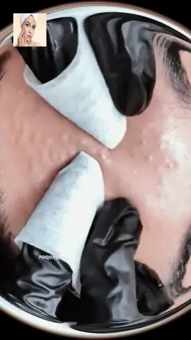 #squeeze #squeezeyuk #acne #pimple #pimplepop #blackhead #satisfying #foryoupage 98