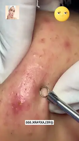 #squeeze #squeezeyuk #acne #pimple #pimplepop #blackhead #satisfying #foryoupage 131